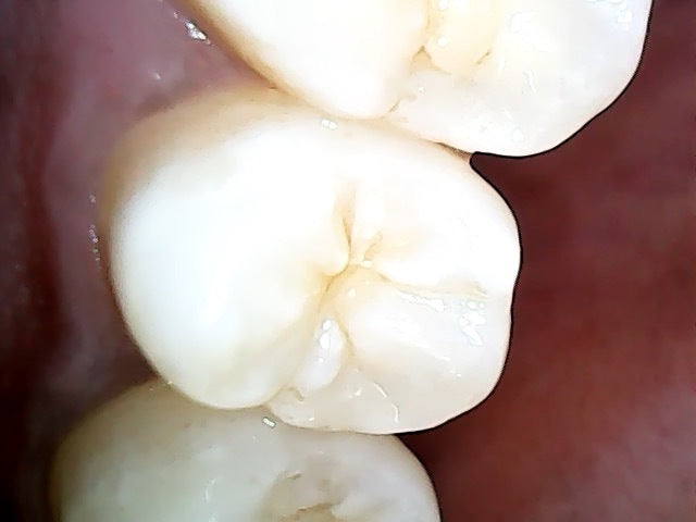 Wireless Personal Oral Health Tracking Camera - Includes Mirror and Retractors